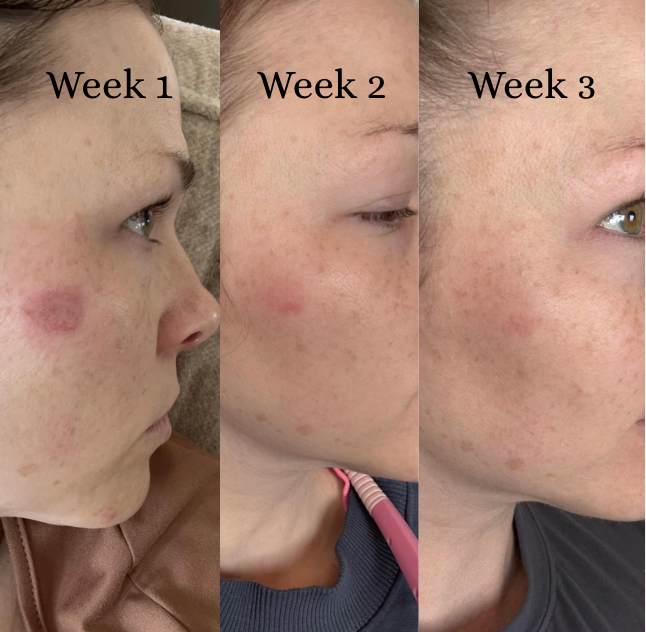 Relevé™ All-in-One Scar Solution