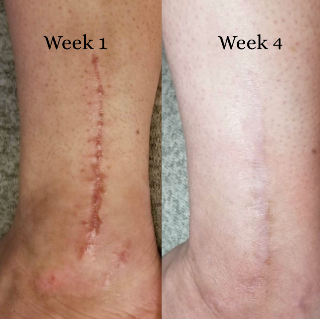 Relevé™ All-in-One Scar Solution